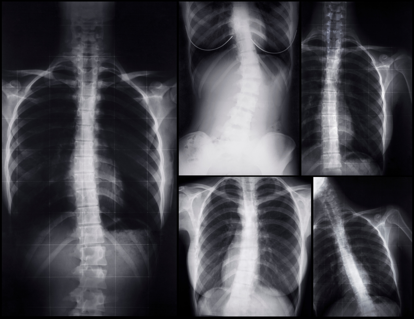 Scoliosis Xrays of a Woman Body